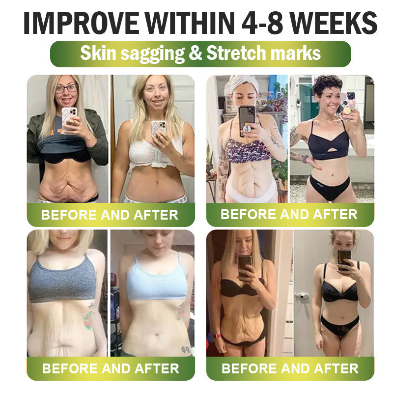 🎁CA Clinically Proven|Official Store | CrazyLeaf® SMGT-GLP-1 Nano Microneedle Patch with Collagen & Matrixyl 3000 丨Targets Obesity, Loose Skin, High Blood Pressure, Diabetes, Fatty Liver, Joint Pain, Brain Fog, Low Energy, Body Aches, and More