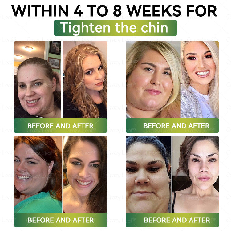 🎁CA Clinically Proven|Official Store | CrazyLeaf® SMGT-GLP-1 Nano Microneedle Patch with Collagen & Matrixyl 3000 丨Targets Obesity, Loose Skin, High Blood Pressure, Diabetes, Fatty Liver, Joint Pain, Brain Fog, Low Energy, Body Aches, and More