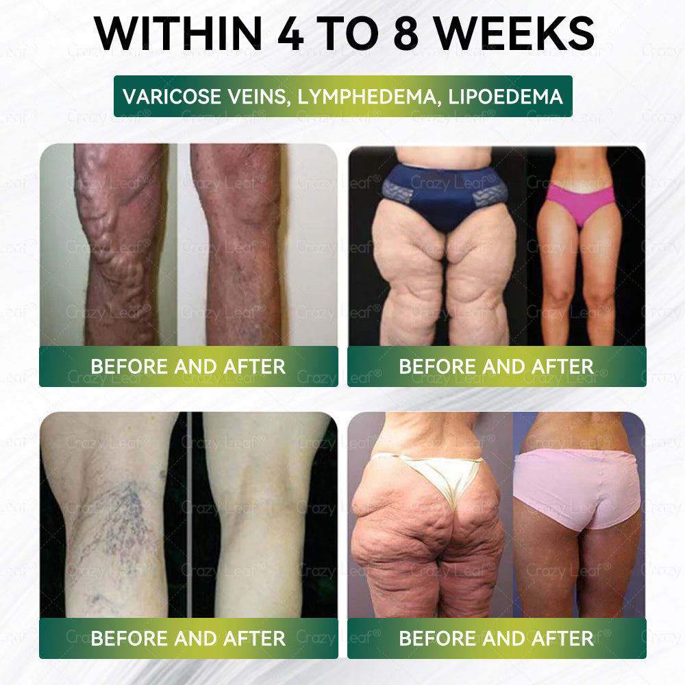 🎁CA Clinically Proven|Official Store | CrazyLeaf® SMGT-GLP-1 Nano Microneedle Patch with Collagen & Matrixyl 3000 丨Targets Obesity, Loose Skin, High Blood Pressure, Diabetes, Fatty Liver, Joint Pain, Brain Fog, Low Energy, Body Aches, and More